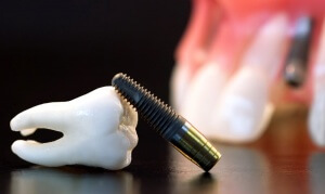 Существует ряд относительных противопоказаний к установке зубных имплантов 