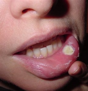 Шишка на внутренней стороне губы